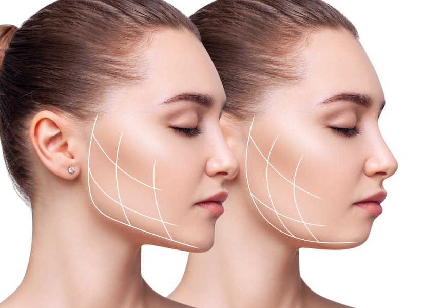 Vorher-Nachher-Darstellung einer Jawline Contouring mit eingezeichneten Lifting-Linien im Wangenbereich